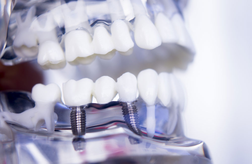 Implantologia- Studio Odontoiatrico Associato a Genova - Studio Dentistico Solimei