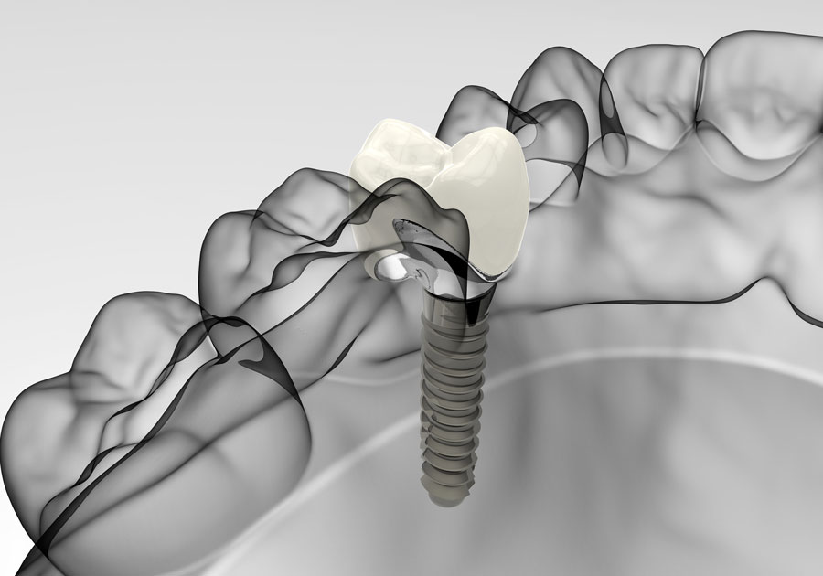 Implantologia- Studio Odontoiatrico Associato a Genova - Studio Dentistico Solimei