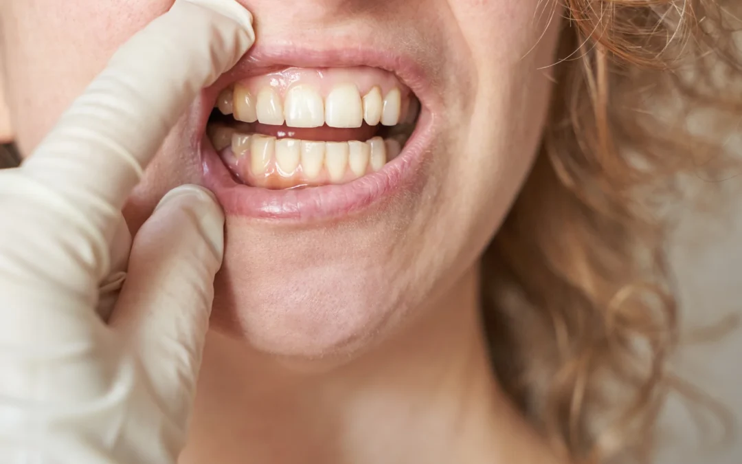 Bruxismo: cosa succede quando serri o digrigni i denti senza accorgertene