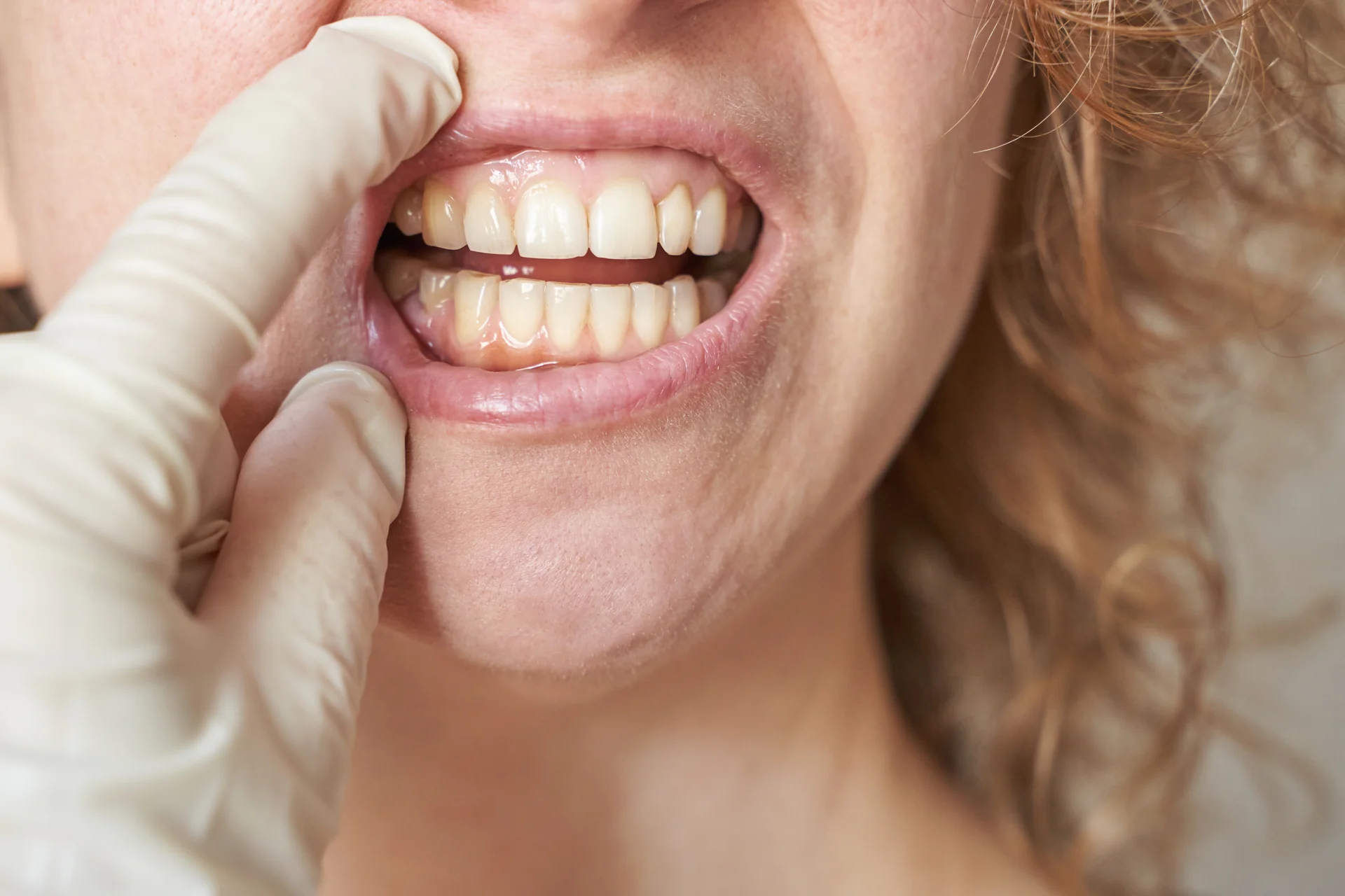 Studio dentistico Solimei Genova – Bruxismo – Donna con denti ususrati_1920x1280